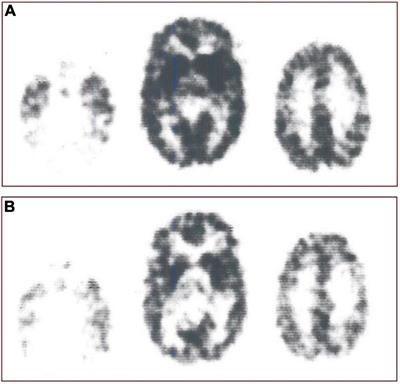 Four decades of mapping and quantifying neuroreceptors at work in vivo by positron emission tomography